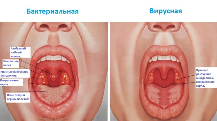 chomu u ditini chervone gorlo chim yogo l kuvati tabletki spre poloskannya ngalyac narodn ta nsh koshti v deo komarovs kogo 2 - Чому у дитини червоне горло і чим його лікувати: таблетки, спреї, полоскання, інгаляції, народні та інші кошти + відео Комаровського