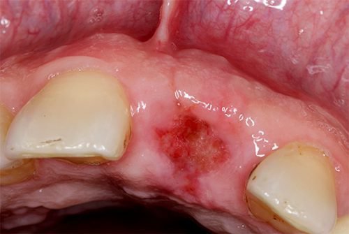 d rka v desn p slya vidalennya zuba etapi zago nnya rani 3 - Дірка в десні після видалення зуба, етапи загоєння рани