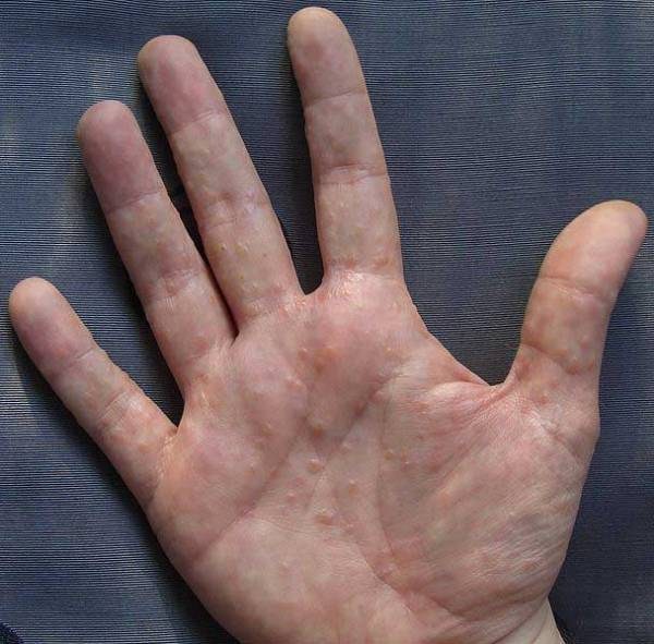 d sg drot cheskaya ekzema kistey pal c v ruk a takozh n g l kuvannya prichini d ta simptomi z foto 2 - Дісгідротіческая екзема кистей і пальців рук, а також ніг: лікування, причини, дієта, симптоми з фото
