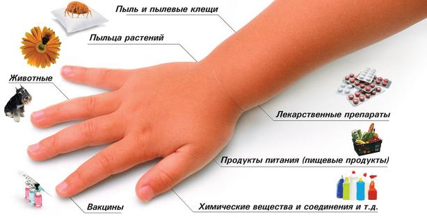d sg drot cheskaya ekzema kistey pal c v ruk a takozh n g l kuvannya prichini d ta simptomi z foto 4 - Дісгідротіческая екзема кистей і пальців рук, а також ніг: лікування, причини, дієта, симптоми з фото
