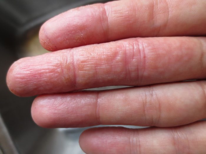 d sg drot cheskaya ekzema kistey pal c v ruk a takozh n g l kuvannya prichini d ta simptomi z foto 5 - Дісгідротіческая екзема кистей і пальців рук, а також ніг: лікування, причини, дієта, симптоми з фото