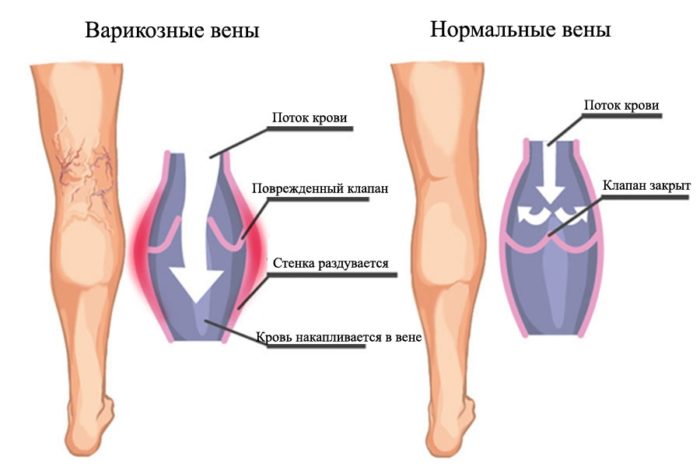 dermatit nizhn h k nc vok u doroslih u tomu chisl varikozniy nfekc yniy simptomi zahvoryuvannya l kuvannya n g z foto 3 - Дерматит нижніх кінцівок у дорослих, у тому числі варикозний, інфекційний: симптоми захворювання і лікування ніг з фото