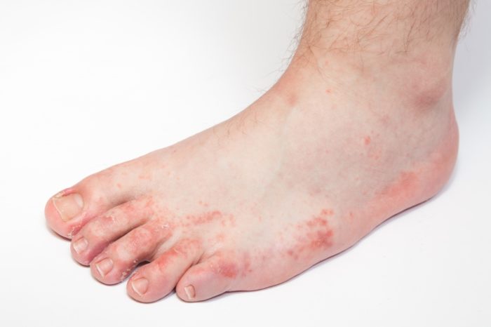 dermatit nizhn h k nc vok u doroslih u tomu chisl varikozniy nfekc yniy simptomi zahvoryuvannya l kuvannya n g z foto 4 - Дерматит нижніх кінцівок у дорослих, у тому числі варикозний, інфекційний: симптоми захворювання і лікування ніг з фото