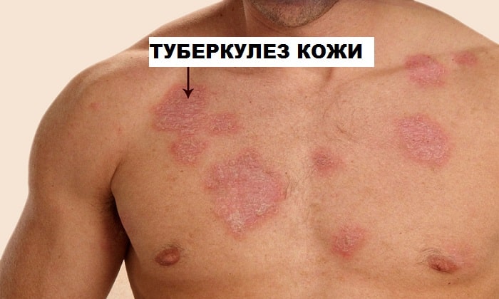 dermozolon nstrukc ya z zastosuvannya c na v dguki analogi 2 - ДЕРМОЗОЛОН – інструкція із застосування, ціна, відгуки і аналоги