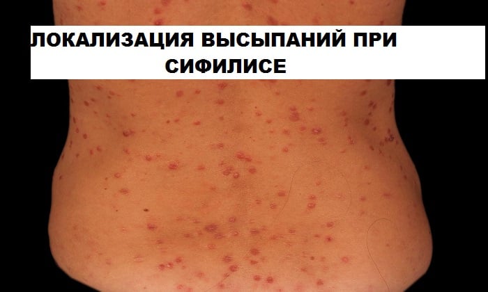 dermozolon nstrukc ya z zastosuvannya c na v dguki analogi 3 - ДЕРМОЗОЛОН – інструкція із застосування, ціна, відгуки і аналоги