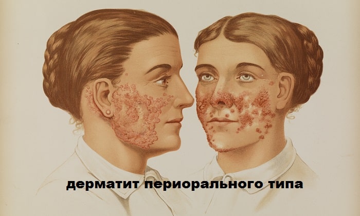 dermozolon nstrukc ya z zastosuvannya c na v dguki analogi 4 - ДЕРМОЗОЛОН – інструкція із застосування, ціна, відгуки і аналоги