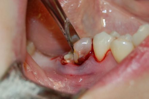 desna p slya vidalennya zuba zago nnya proceduri mozhliv uskladnennya 4 - Десна після видалення зуба: загоєння, процедури, можливі ускладнення
