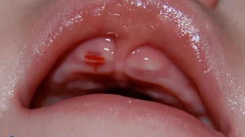 desna pri pror zuvann zub v u nemovlyat yak viglyadayut krovotochiv st 1 - Десна при прорізуванні зубів у немовлят: як виглядають, кровоточивість