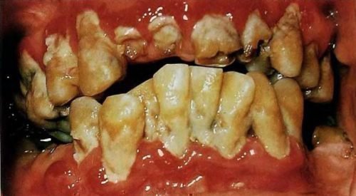 diferenc al na d agnostika parodontitu komp yuterna tomograf ya zub v 2 - диференціальна Діагностика пародонтиту, комп’ютерна томографія зубів