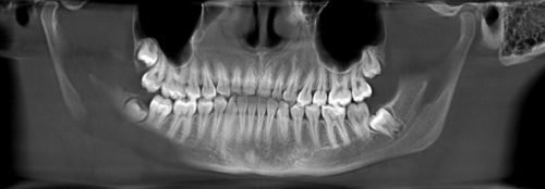 diferenc al na d agnostika parodontitu komp yuterna tomograf ya zub v 3 - диференціальна Діагностика пародонтиту, комп’ютерна томографія зубів