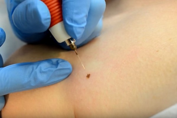 displastichniy nevus scho ce take foto prichini simptomi d agnostika metodi l kuvannya vidalennya 11 - Диспластичний невус: що це таке, фото, причини, симптоми, діагностика, методи лікування і видалення
