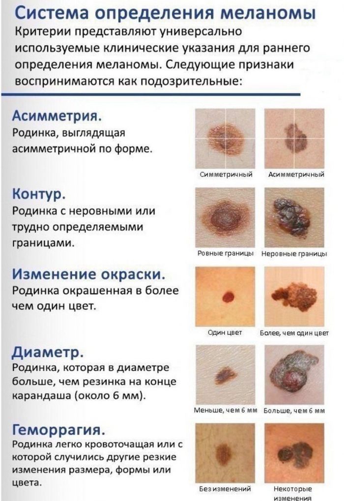 displastichniy nevus scho ce take foto prichini simptomi d agnostika metodi l kuvannya vidalennya 17 - Диспластичний невус: що це таке, фото, причини, симптоми, діагностика, методи лікування і видалення