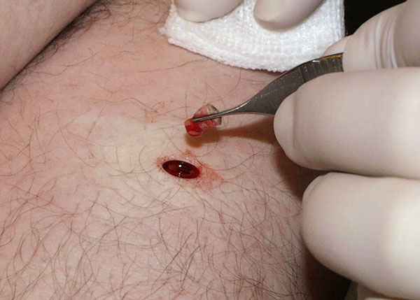 displastichniy nevus scho ce take foto prichini simptomi d agnostika metodi l kuvannya vidalennya 19 - Диспластичний невус: що це таке, фото, причини, симптоми, діагностика, методи лікування і видалення