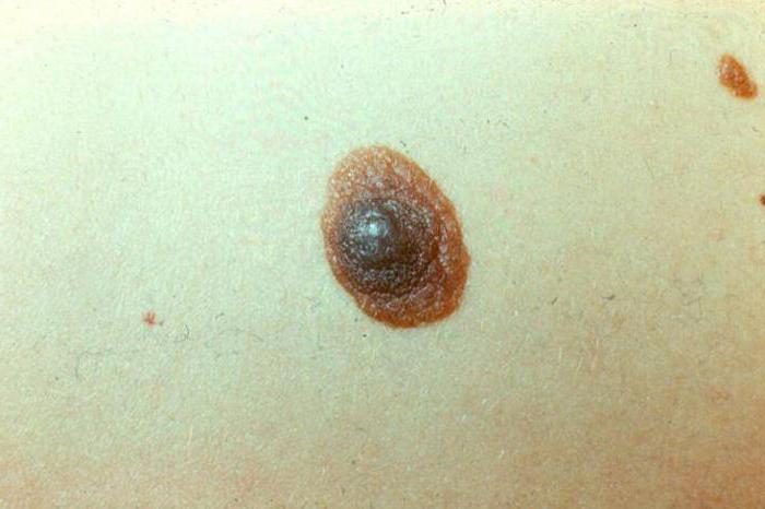 displastichniy nevus scho ce take foto prichini simptomi d agnostika metodi l kuvannya vidalennya 2 - Диспластичний невус: що це таке, фото, причини, симптоми, діагностика, методи лікування і видалення