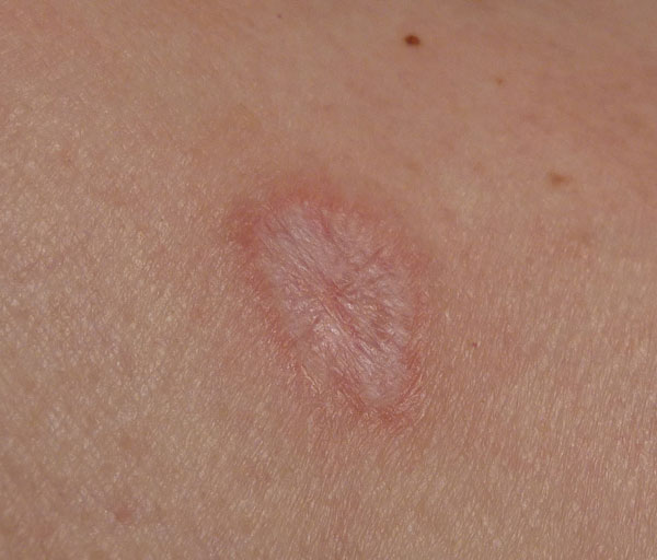 displastichniy nevus scho ce take foto prichini simptomi d agnostika metodi l kuvannya vidalennya 20 - Диспластичний невус: що це таке, фото, причини, симптоми, діагностика, методи лікування і видалення