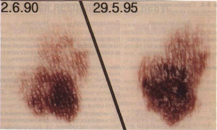 displastichniy nevus scho ce take foto prichini simptomi d agnostika metodi l kuvannya vidalennya 23 - Диспластичний невус: що це таке, фото, причини, симптоми, діагностика, методи лікування і видалення