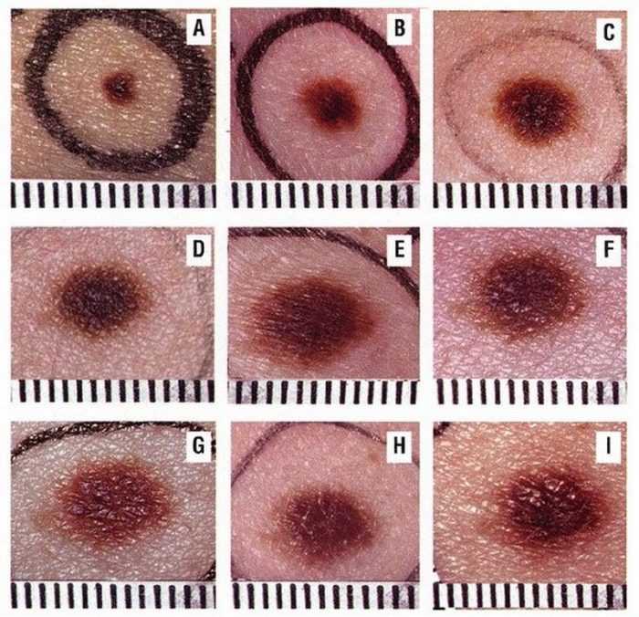 displastichniy nevus scho ce take foto prichini simptomi d agnostika metodi l kuvannya vidalennya 3 - Диспластичний невус: що це таке, фото, причини, симптоми, діагностика, методи лікування і видалення