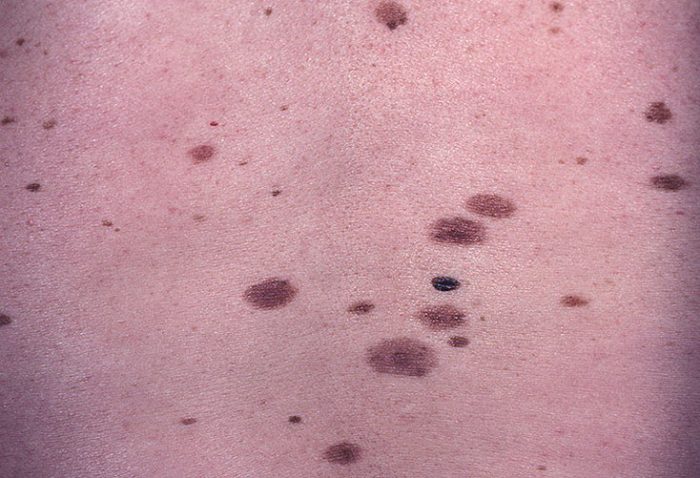 displastichniy nevus scho ce take foto prichini simptomi d agnostika metodi l kuvannya vidalennya 4 - Диспластичний невус: що це таке, фото, причини, симптоми, діагностика, методи лікування і видалення