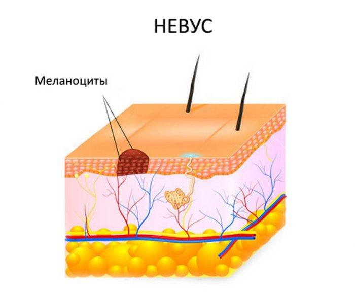 displastichniy nevus scho ce take foto prichini simptomi d agnostika metodi l kuvannya vidalennya 5 - Диспластичний невус: що це таке, фото, причини, симптоми, діагностика, методи лікування і видалення