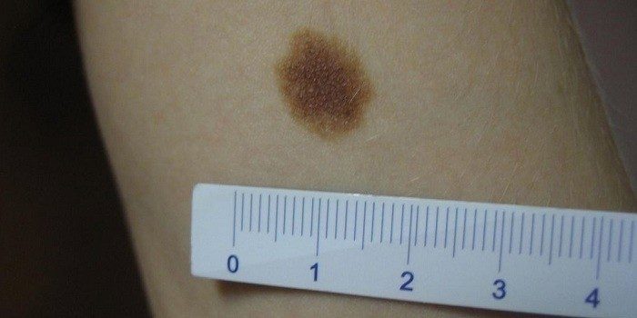 displastichniy nevus scho ce take foto prichini simptomi d agnostika metodi l kuvannya vidalennya 7 - Диспластичний невус: що це таке, фото, причини, симптоми, діагностика, методи лікування і видалення