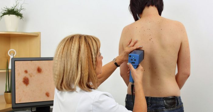 displastichniy nevus scho ce take foto prichini simptomi d agnostika metodi l kuvannya vidalennya 8 - Диспластичний невус: що це таке, фото, причини, симптоми, діагностика, методи лікування і видалення