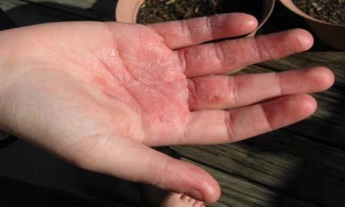 ЭКОДАКС – інструкція із застосування, ціна, відгуки і аналоги ekodaks nstrukc ya z zastosuvannya c na v dguki analogi 4 - ЭКОДАКС – інструкція із застосування, ціна, відгуки і аналоги