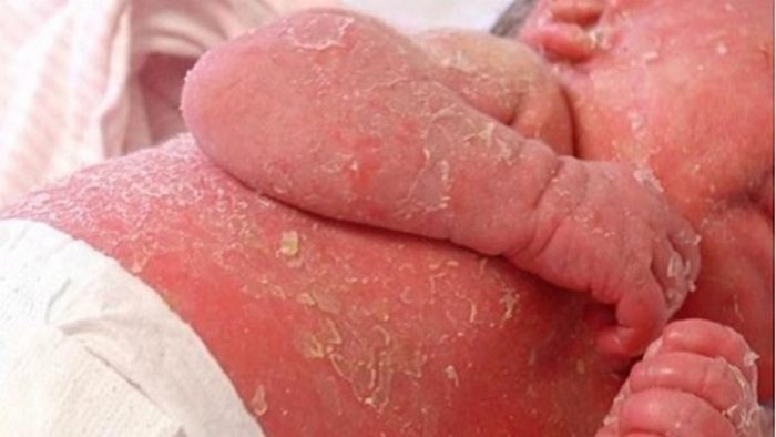 eksfol ativniy dermatit r ttera u doroslih d tey u tomu chisl novonarodzhenih foto 11 - Ексфоліативний дерматит (Ріттера) у дорослих і дітей, у тому числі новонароджених, фото