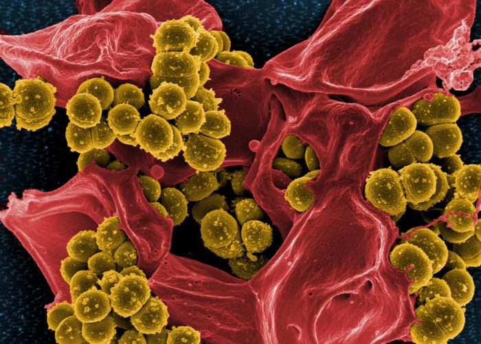 eksfol ativniy dermatit r ttera u doroslih d tey u tomu chisl novonarodzhenih foto 3 - Ексфоліативний дерматит (Ріттера) у дорослих і дітей, у тому числі новонароджених, фото