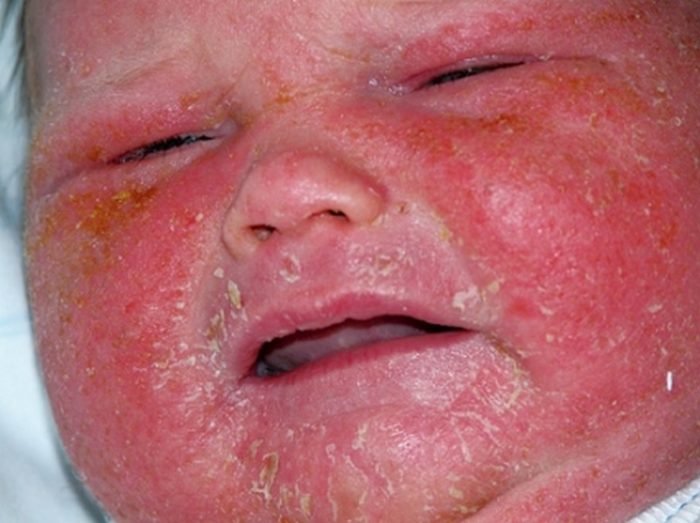 eksfol ativniy dermatit r ttera u doroslih d tey u tomu chisl novonarodzhenih foto 4 - Ексфоліативний дерматит (Ріттера) у дорослих і дітей, у тому числі новонароджених, фото