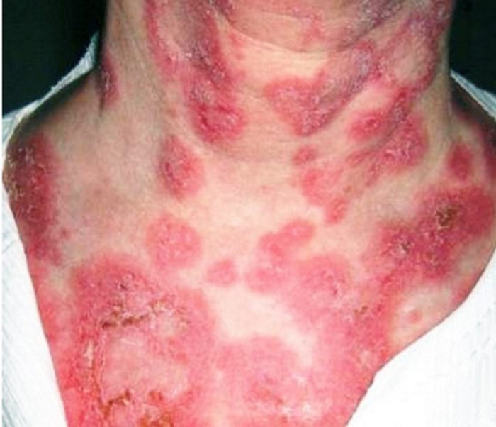 eksfol ativniy dermatit r ttera u doroslih d tey u tomu chisl novonarodzhenih foto 5 - Ексфоліативний дерматит (Ріттера) у дорослих і дітей, у тому числі новонароджених, фото