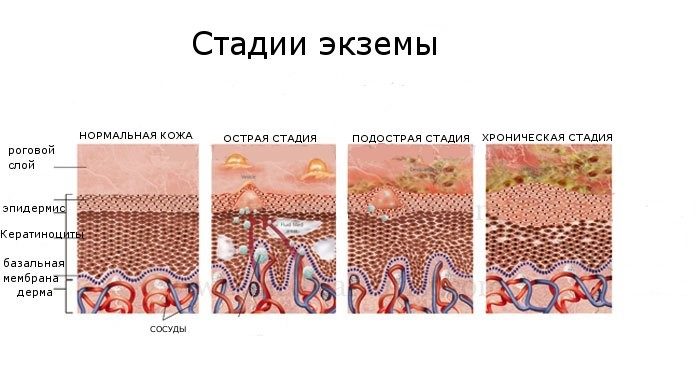 ekzema na golov u voloss chim l kuvati simptomi ta d agnostika foto 3 - Екзема на голові у волоссі: чим лікувати, симптоми та діагностика + фото