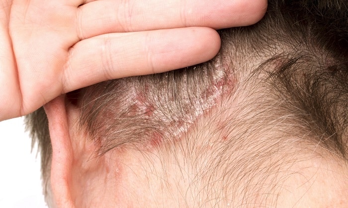 ekzo derm nstrukc ya z zastosuvannya c na v dguki analogi 3 - ЕКЗО-ДЕРМ – інструкція із застосування, ціна, відгуки і аналоги