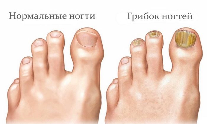 ekzo derm nstrukc ya z zastosuvannya c na v dguki analogi 4 - ЕКЗО-ДЕРМ – інструкція із застосування, ціна, відгуки і аналоги