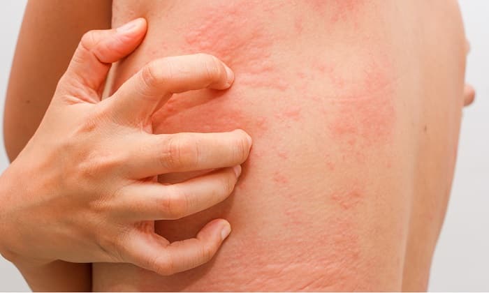 ekzo derm nstrukc ya z zastosuvannya c na v dguki analogi 7 - ЕКЗО-ДЕРМ – інструкція із застосування, ціна, відгуки і аналоги