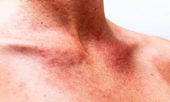 ekzo derm nstrukc ya z zastosuvannya c na v dguki analogi 9 - ЕКЗО-ДЕРМ – інструкція із застосування, ціна, відгуки і аналоги