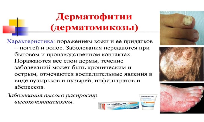 ЭКЗОЛОЦИН від ГРИБКА: відгуки, ціна, склад і чи варто купувати ekzolocin v d gribka v dguki c na sklad chi varto kupuvati 2 - ЭКЗОЛОЦИН від ГРИБКА: відгуки, ціна, склад і чи варто купувати