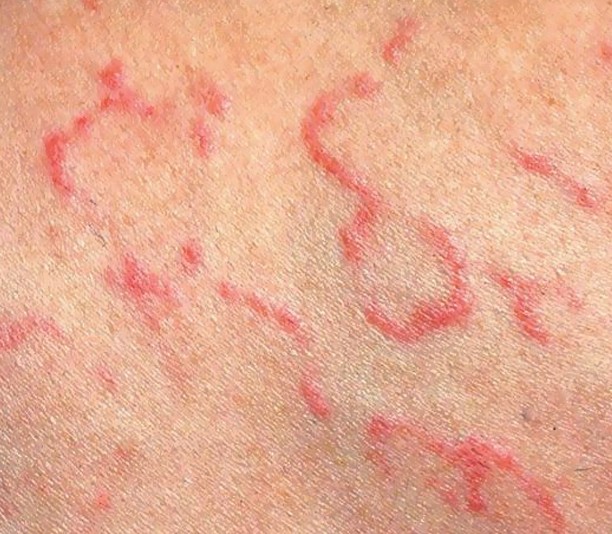 eritema u d tey v tomu chisl novonarodzhenih simptomi l kuvannya nfekc yno bagatoformna eksudativno ta nshih form 13 - Еритема у дітей, в тому числі новонароджених: симптоми і лікування інфекційної, багатоформна, ексудативної та інших форм