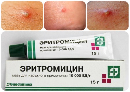 eritrom cin v tabletkah eritromicinovaya maz v d prisch v zastosuvannya ta v dguki 2 - Еритроміцин в таблетках і эритромициновая мазь від прищів: застосування та відгуки