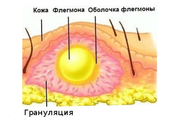 flegmona shi scho ce take simptomi trival st l kuvannya chomu utvoryu t sya gn yne zapalennya 3 - Флегмона шиї: що це таке, симптоми, тривалість лікування і чому утворюється гнійне запалення