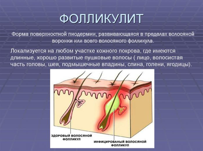 fol kul t scho ce take prichini follikuleza l kuvannya zapalennya volosyanogo fol kula foto 2 - Фолікуліт: що це таке, причини фолликулеза, лікування запалення волосяного фолікула, фото