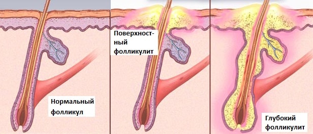 fol kul t scho ce take prichini follikuleza l kuvannya zapalennya volosyanogo fol kula foto 6 - Фолікуліт: що це таке, причини фолликулеза, лікування запалення волосяного фолікула, фото
