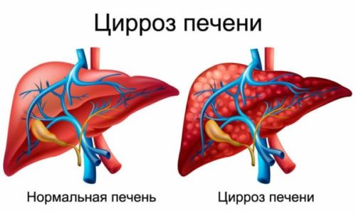 Форми алкогольної хвороби печінки та їх лікування formi alkogol no hvorobi pech nki ta h l kuvannya 2 - Форми алкогольної хвороби печінки та їх лікування