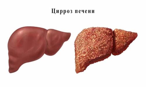 Форми алкогольної хвороби печінки та їх лікування formi alkogol no hvorobi pech nki ta h l kuvannya 7 - Форми алкогольної хвороби печінки та їх лікування
