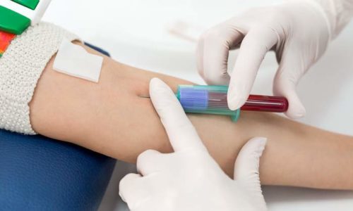 Форми алкогольної хвороби печінки та їх лікування formi alkogol no hvorobi pech nki ta h l kuvannya 8 - Форми алкогольної хвороби печінки та їх лікування