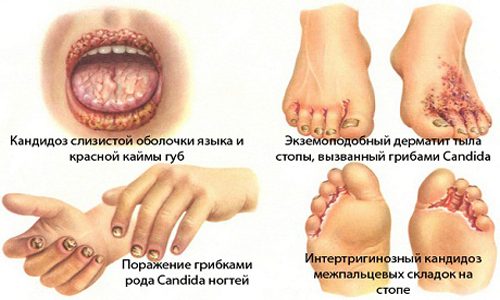 ФУНГИСАН – інструкція із застосування, ціна, відгуки і аналоги fungisan nstrukc ya z zastosuvannya c na v dguki analogi 2 - ФУНГИСАН – інструкція із застосування, ціна, відгуки і аналоги