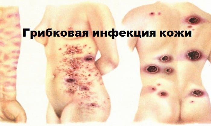 ФУНГОТЕРБИН НЕО – інструкція із застосування, ціна, відгуки і аналоги fungoterbin neo nstrukc ya z zastosuvannya c na v dguki analogi 3 - ФУНГОТЕРБИН НЕО – інструкція із застосування, ціна, відгуки і аналоги