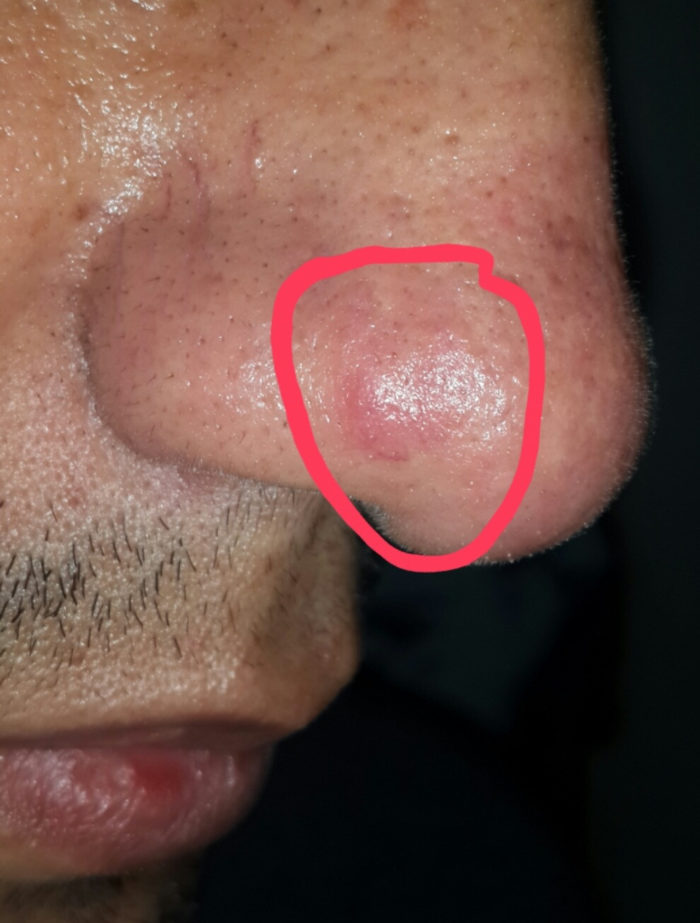 furunkul na nos prichini poyavi yak l kuvati chiryak dopomoga v domashn h umovah uskladnennya foto v deo po tem 4 - Фурункул на носі: причини появи, як лікувати чиряк, допомога в домашніх умовах, ускладнення, фото і відео по темі