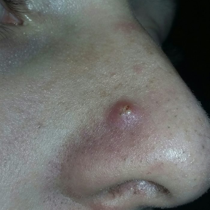 furunkul na nos prichini poyavi yak l kuvati chiryak dopomoga v domashn h umovah uskladnennya foto v deo po tem 5 - Фурункул на носі: причини появи, як лікувати чиряк, допомога в домашніх умовах, ускладнення, фото і відео по темі