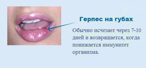 gerpes na gubah sk l ki dn v triva l kuvannya 1 - Герпес на губах: скільки днів триває лікування