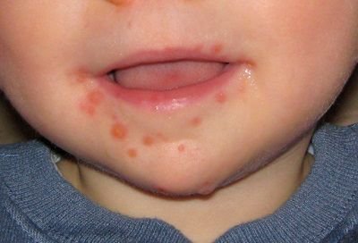 gerpes na gubah u ditini l kuvannya yak viglyada chasto 1 - Герпес на губах у дитини: лікування, як виглядає, часто